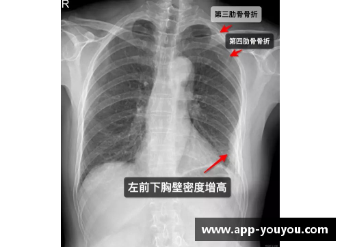 球员肋骨骨折：运动场上的隐形伤痛